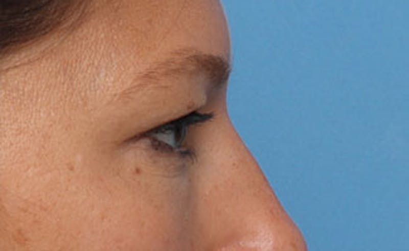 Eyelid Surgery Before & After Gallery - Patient 602784 - Image 7