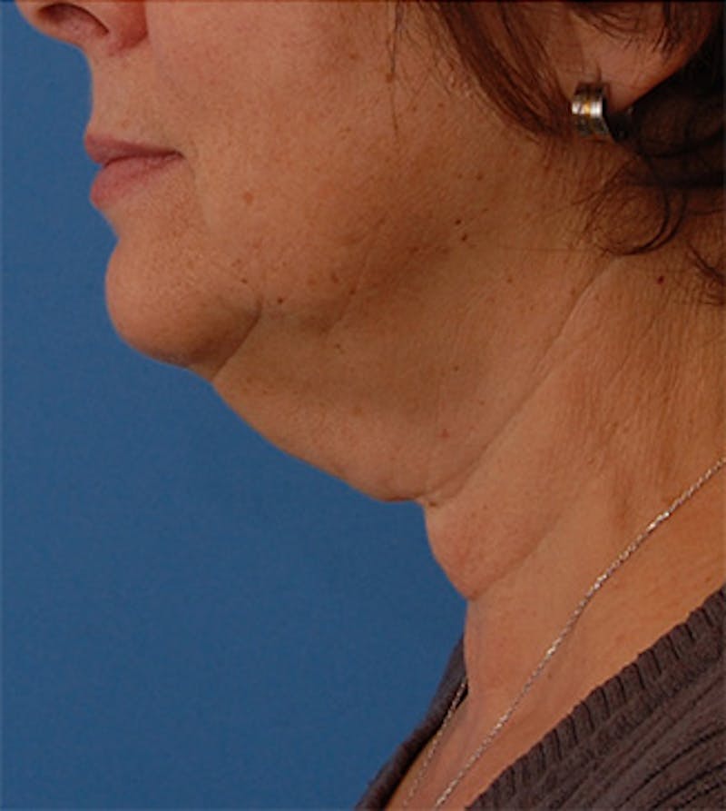 Facelift Before & After Gallery - Patient 177954 - Image 1