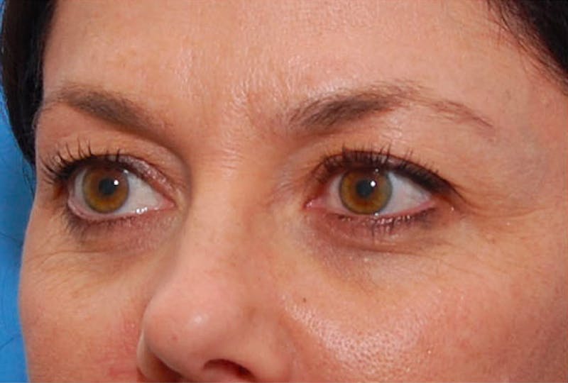BOTOX Before & After Gallery - Patient 422852 - Image 5