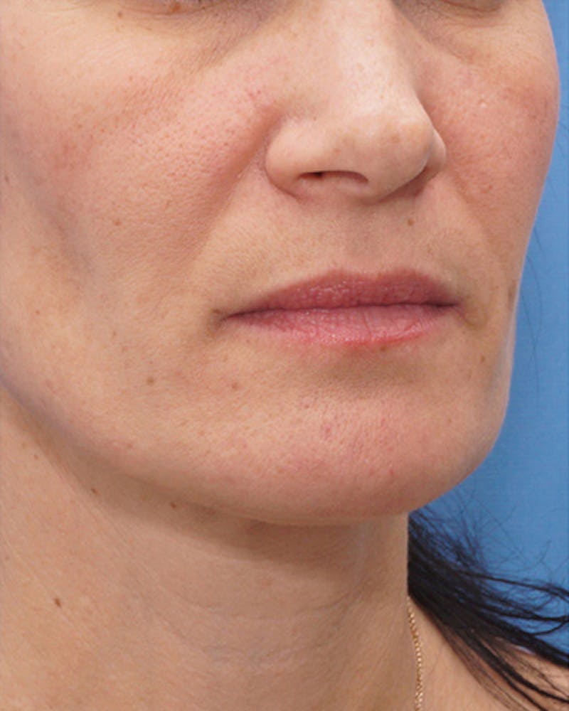 Fillers Before & After Gallery - Patient 734058 - Image 3