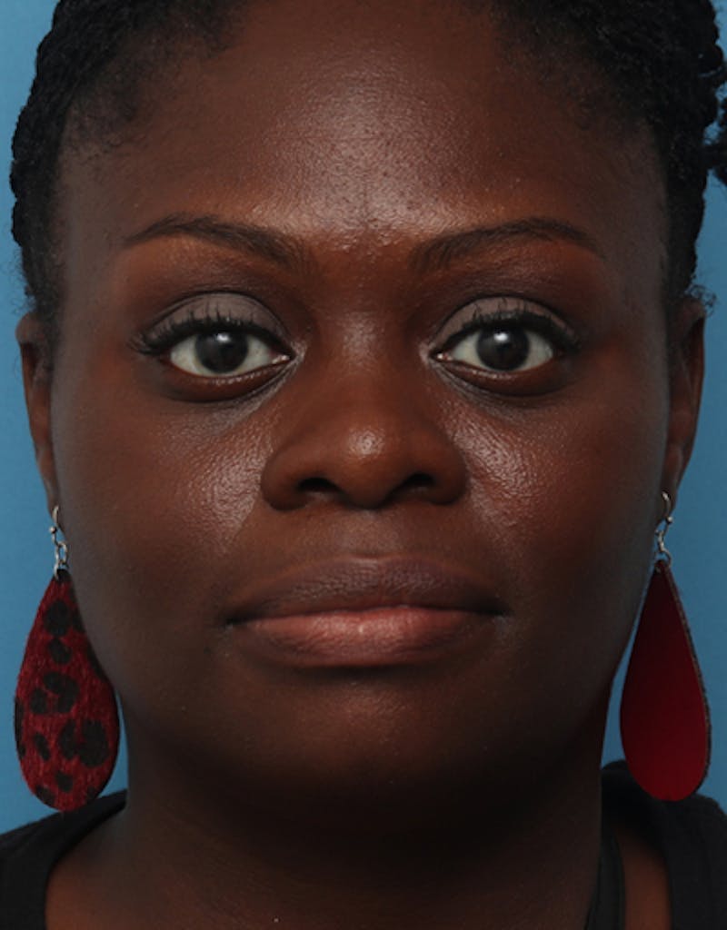 Chin Surgery Before & After Gallery - Patient 825023 - Image 5