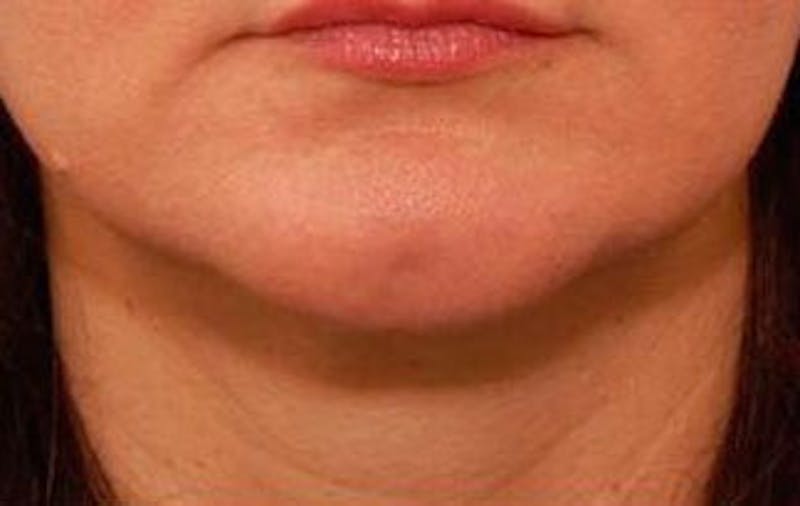 Jawline Contouring Before & After Gallery - Patient 121031 - Image 2