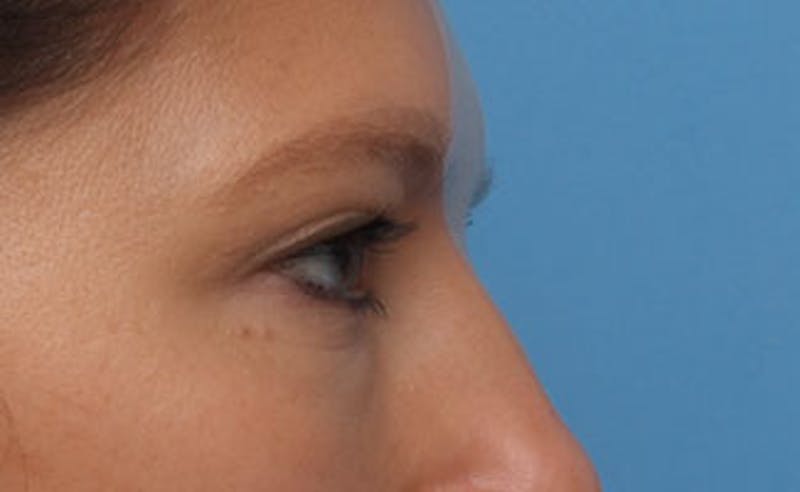 Eyelid Surgery Before & After Gallery - Patient 602784 - Image 8