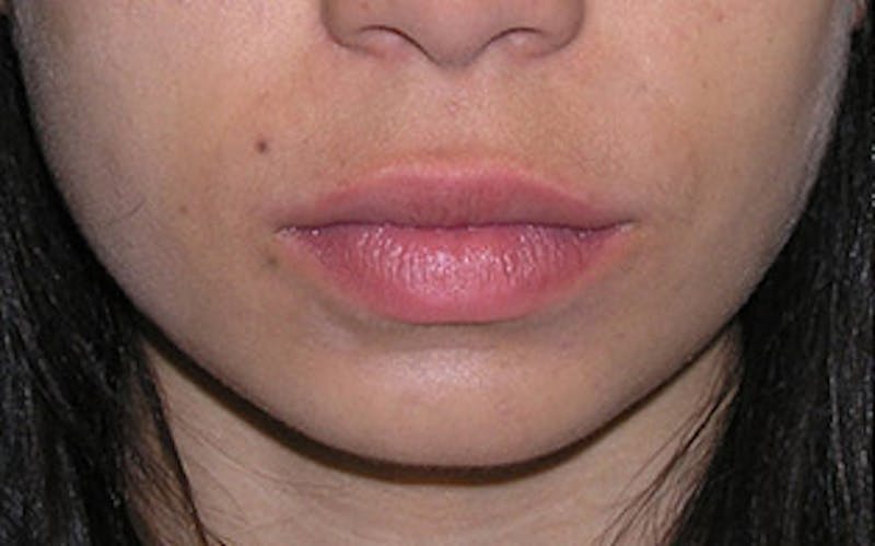 Chin Surgery Before & After Gallery - Patient 388365 - Image 5
