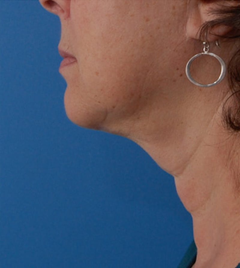 Facelift Before & After Gallery - Patient 177954 - Image 2