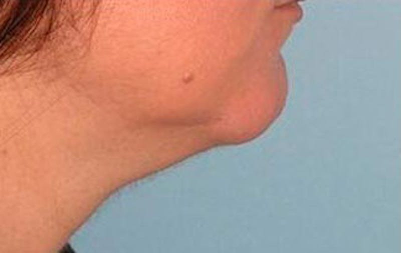 Jawline Contouring Before & After Gallery - Patient 121031 - Image 3