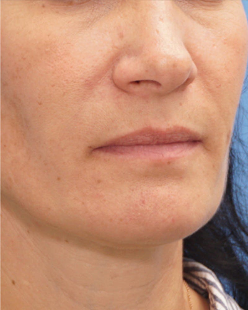 Fillers Before & After Gallery - Patient 734058 - Image 4