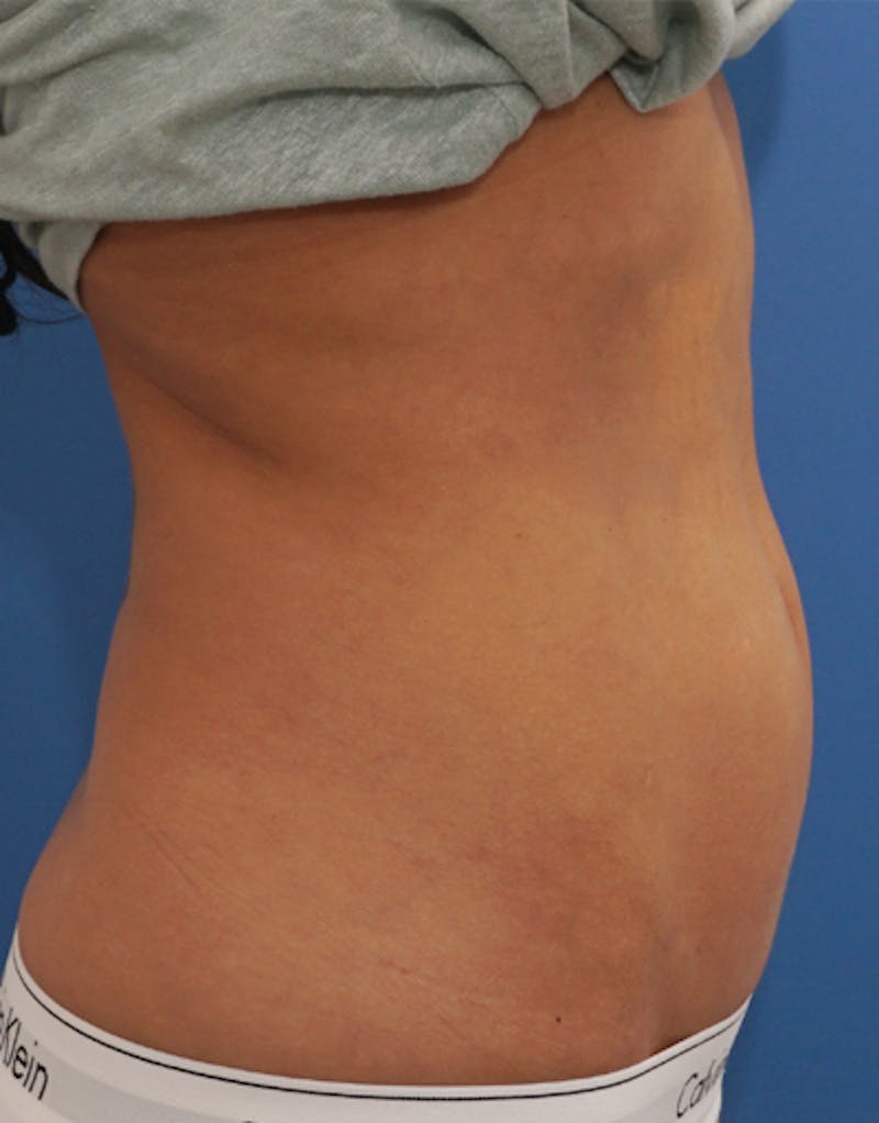 Liposuction (Body) Before & After Gallery - Patient 255887 - Image 5