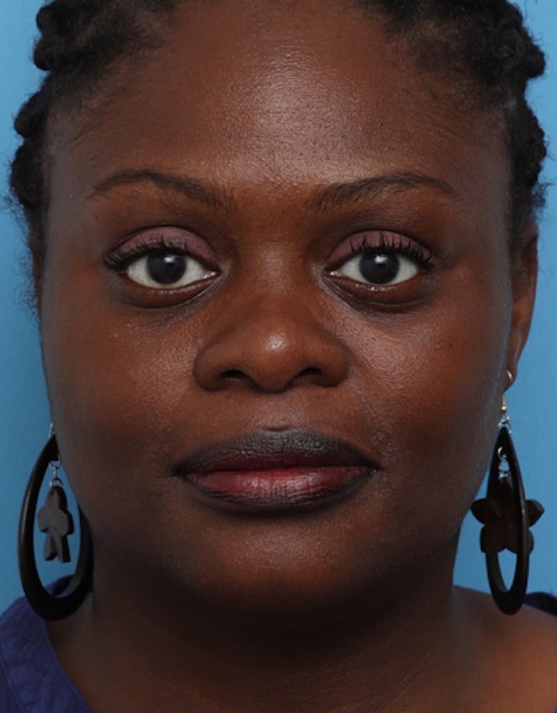 Chin Surgery Before & After Gallery - Patient 825023 - Image 6