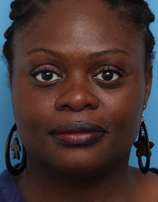 Chin Surgery Before & After Gallery - Patient 825023 - Image 6