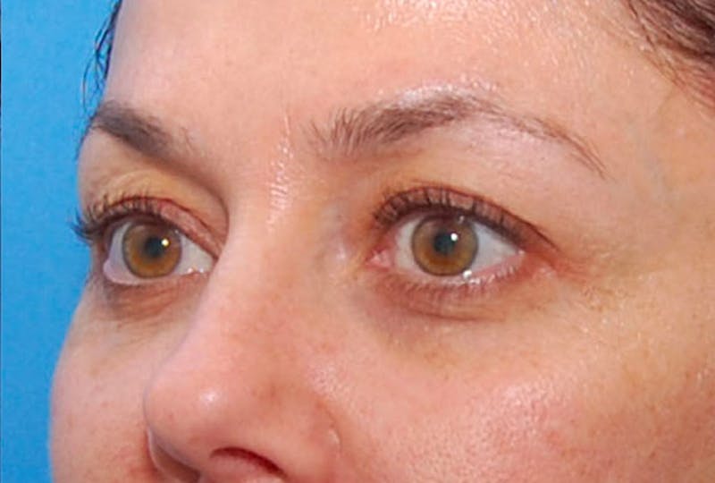 BOTOX Before & After Gallery - Patient 422852 - Image 6