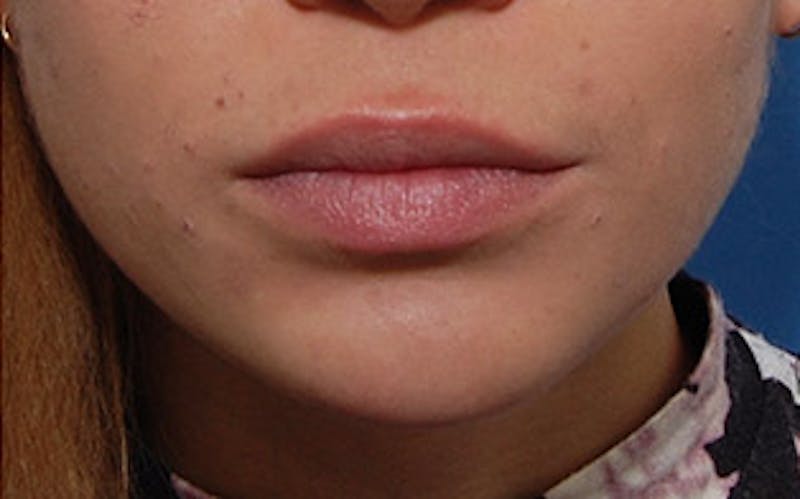 Chin Surgery Before & After Gallery - Patient 388365 - Image 6