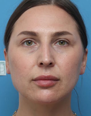 Ear Surgery Before & After Gallery - Patient 329322 - Image 4