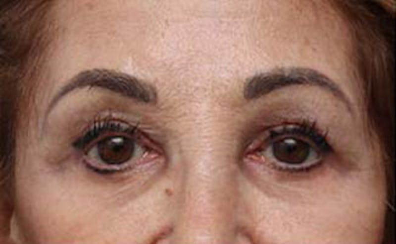 Patient CUmPIODjRH2sZMK0CIn6Vg - Brow Lift Before & After Photos