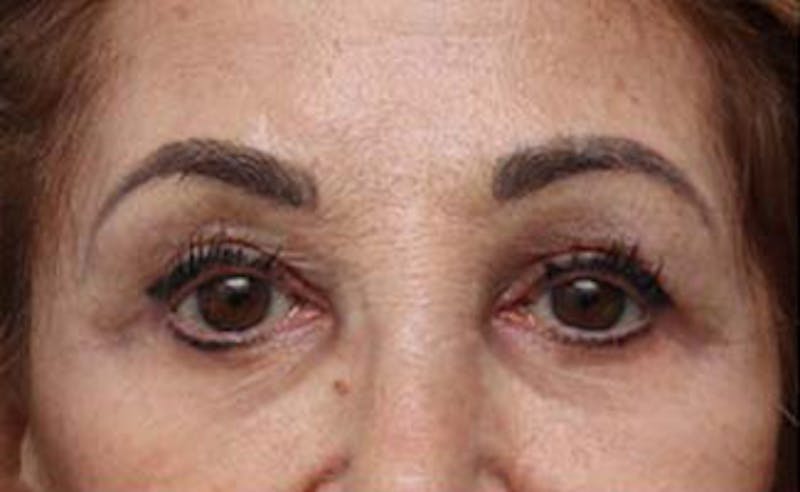 Eyelid Surgery Before & After Gallery - Patient 139797 - Image 1