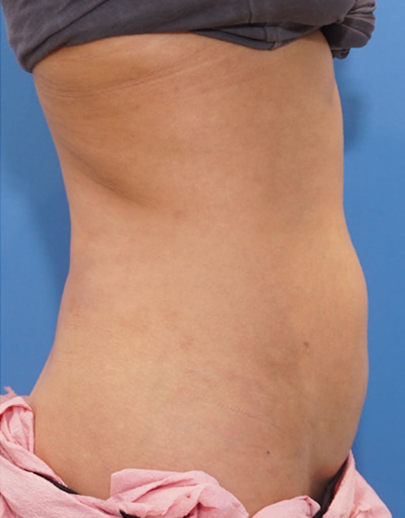 Liposuction (Body) Before & After Gallery - Patient 255887 - Image 6