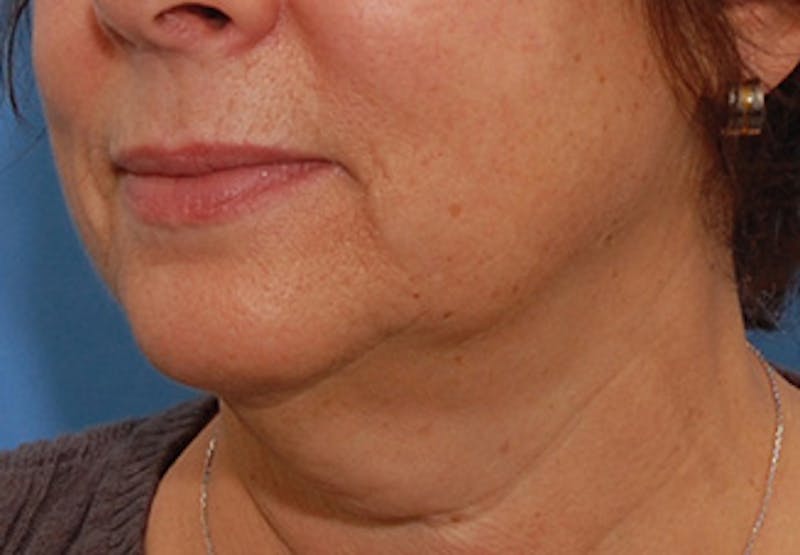 Facelift Before & After Gallery - Patient 177954 - Image 3