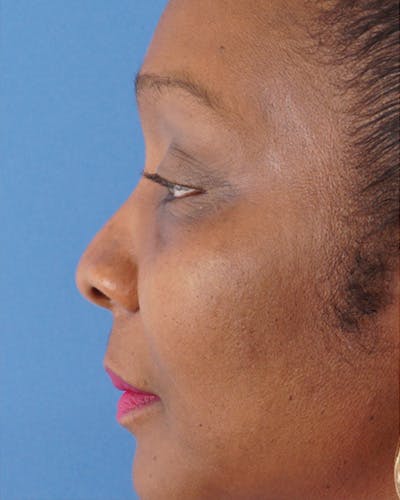 Rhinoplasty Before & After Gallery - Patient 251561 - Image 1