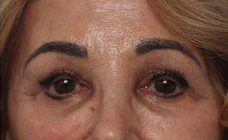 Eyelid Surgery Before & After Gallery - Patient 139797 - Image 2