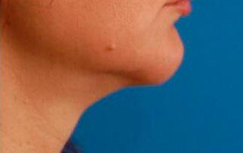 Jawline Contouring Before & After Gallery - Patient 121031 - Image 4