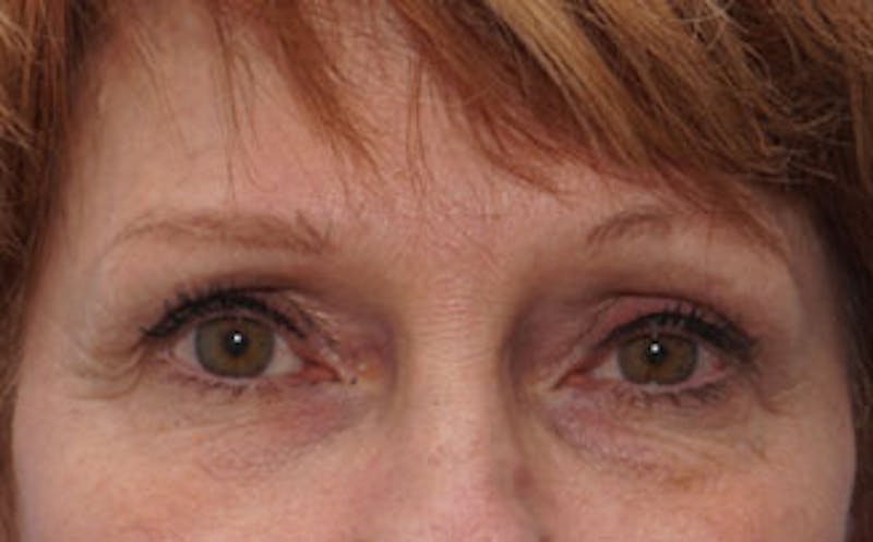 BOTOX Before & After Gallery - Patient 196776 - Image 1