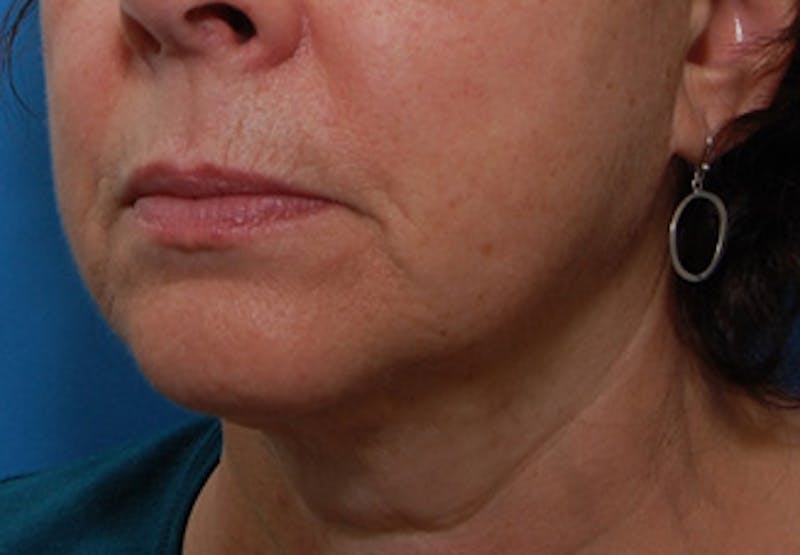 Facelift Before & After Gallery - Patient 177954 - Image 4