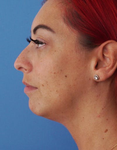 Neck Liposuction Before & After Gallery - Patient 383438 - Image 1