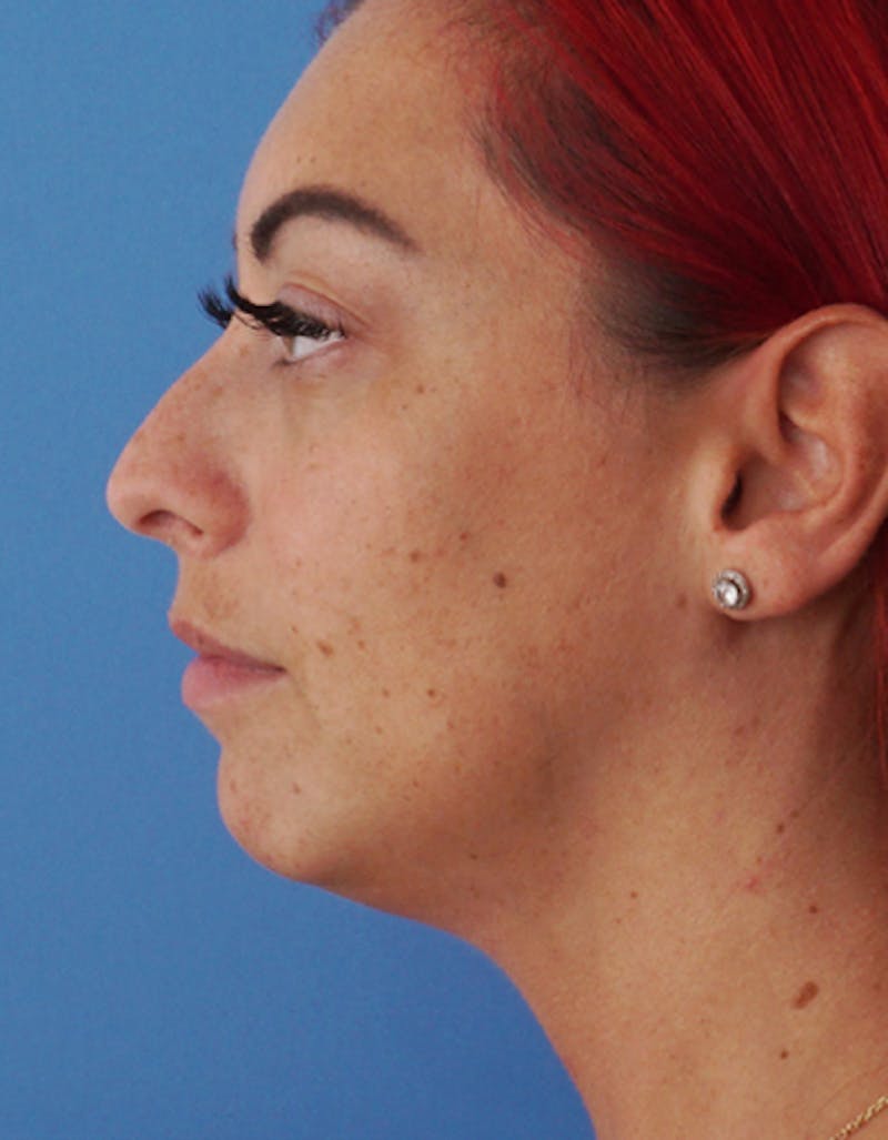 Neck Liposuction Before & After Gallery - Patient 383438 - Image 1
