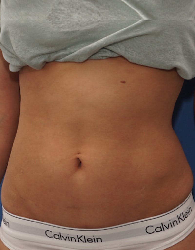 Liposuction (Body) Before & After Gallery - Patient 255887 - Image 7