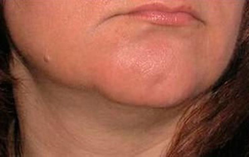 Jawline Contouring Before & After Gallery - Patient 121031 - Image 5