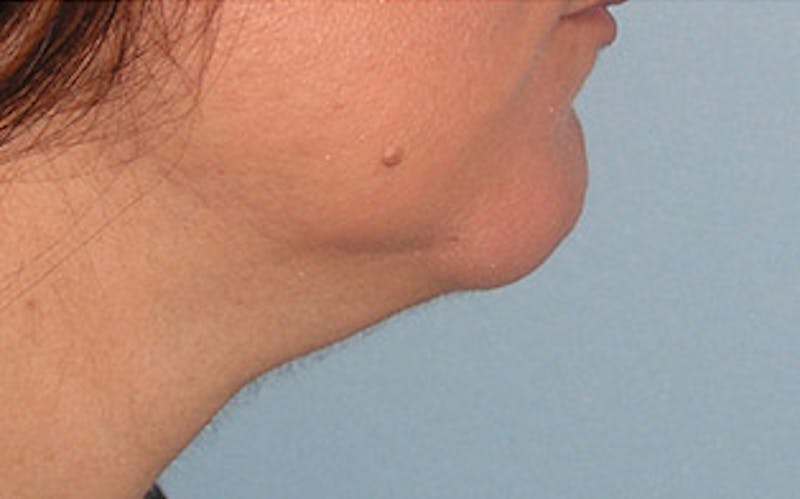 Patient UgDK-QSJSwK_3XdKprbAqA - Chin Surgery Before & After Photos