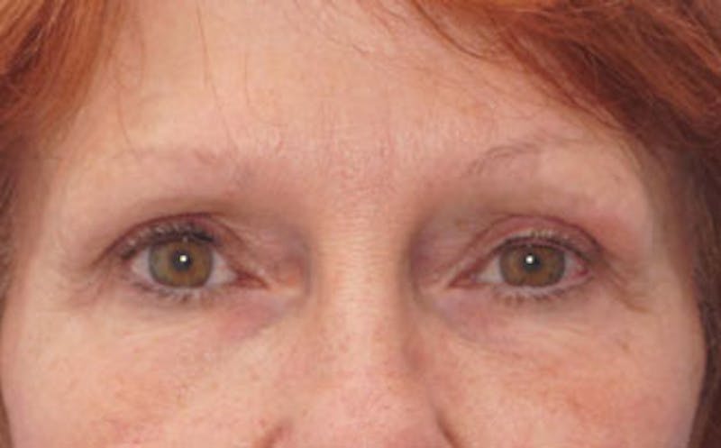 BOTOX Before & After Gallery - Patient 196776 - Image 2