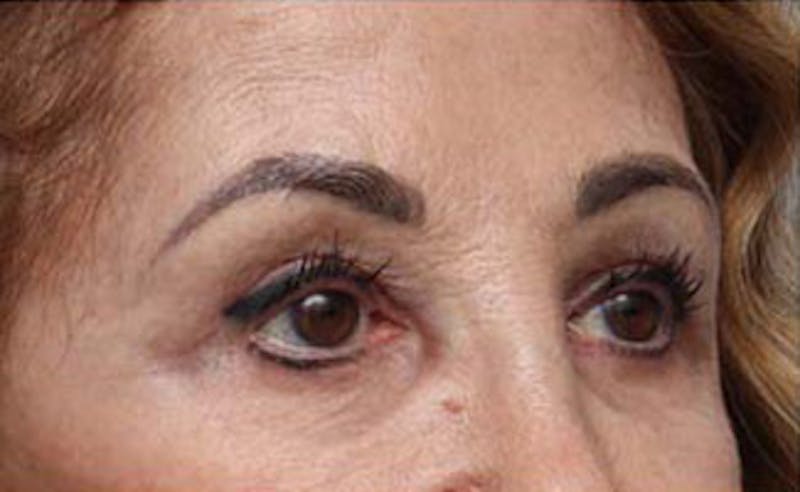 Eyelid Surgery Before & After Gallery - Patient 139797 - Image 3