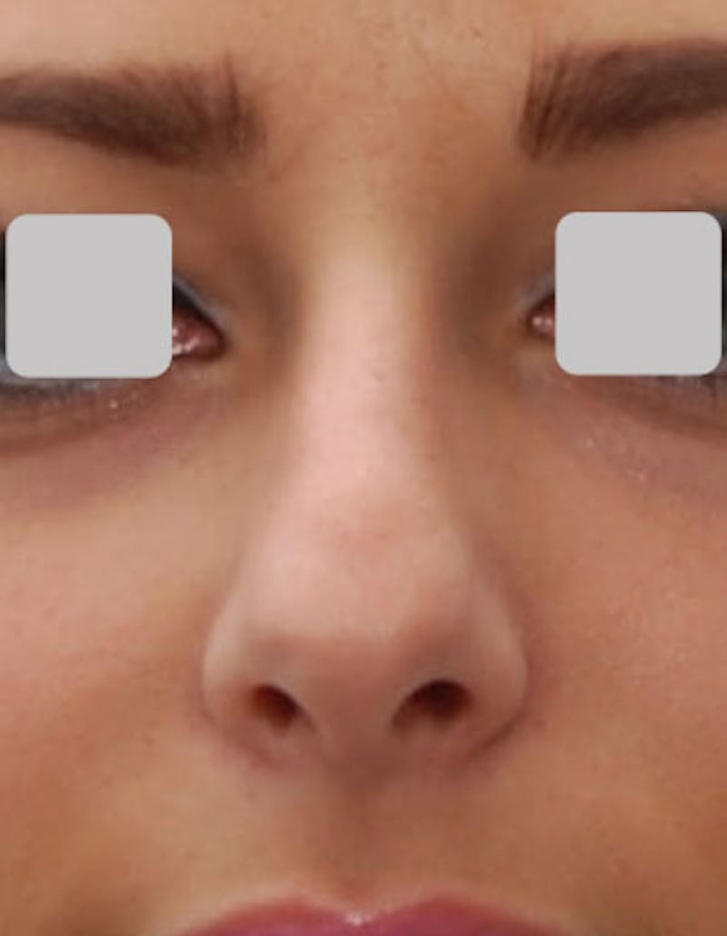 Rhinoplasty Before & After Gallery - Patient 308774 - Image 3