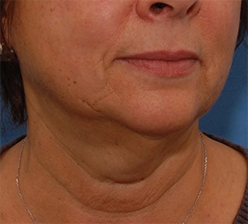 Facelift Before & After Gallery - Patient 177954 - Image 5