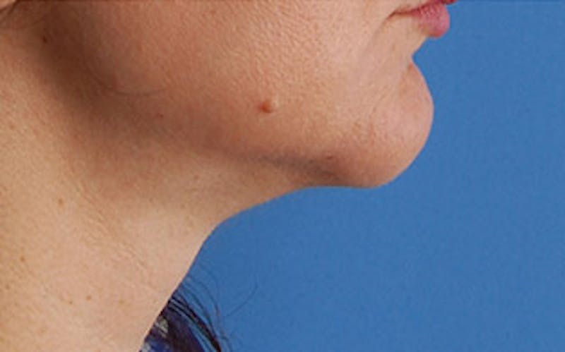 Chin Surgery Before & After Gallery - Patient 134570 - Image 2