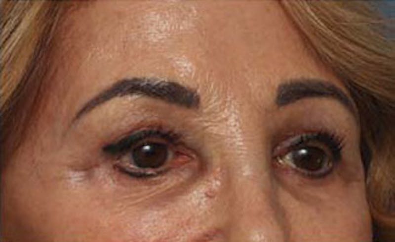 Eyelid Surgery Before & After Gallery - Patient 139797 - Image 4