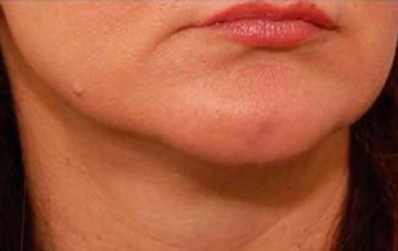 Jawline Contouring Before & After Gallery - Patient 121031 - Image 6