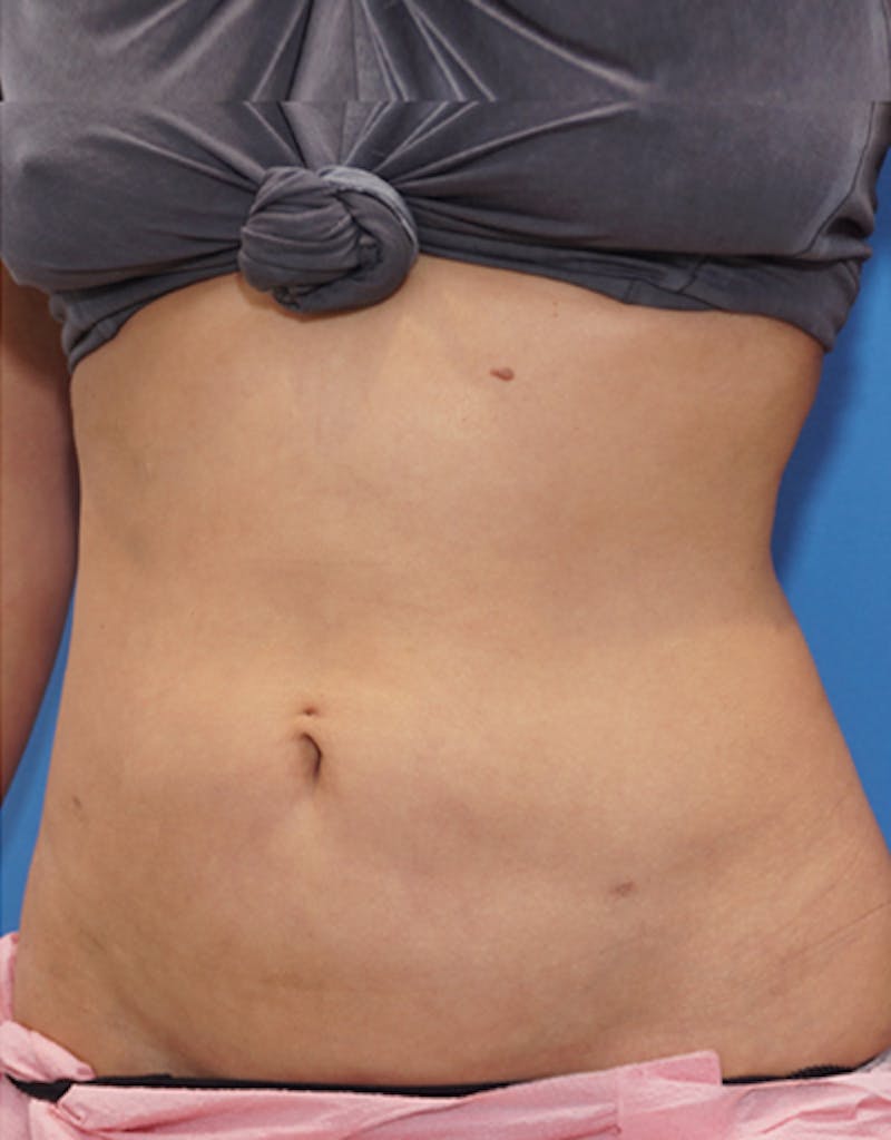 Liposuction (Body) Before & After Gallery - Patient 255887 - Image 8