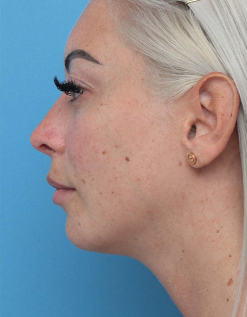 Neck Liposuction Before & After Gallery - Patient 383438 - Image 2