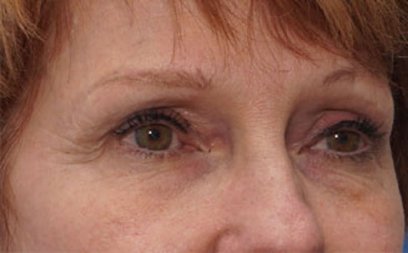 BOTOX Before & After Gallery - Patient 196776 - Image 3