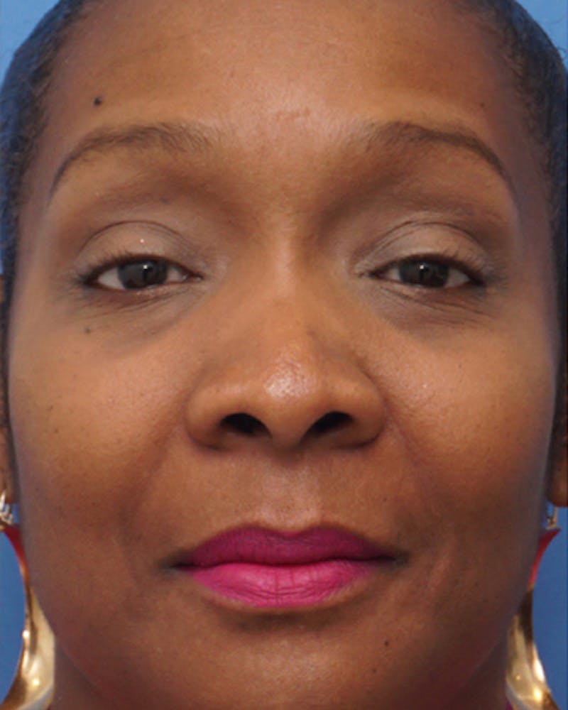 Rhinoplasty  Before & After Gallery - Patient 251561 - Image 3
