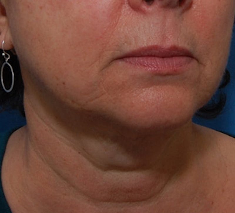 Facelift Before & After Gallery - Patient 177954 - Image 6