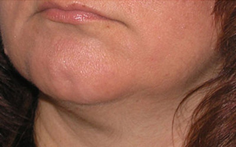 Chin Surgery Before & After Gallery - Patient 134570 - Image 3