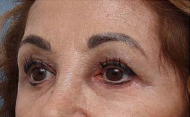 Eyelid Surgery Before & After Gallery - Patient 139797 - Image 5