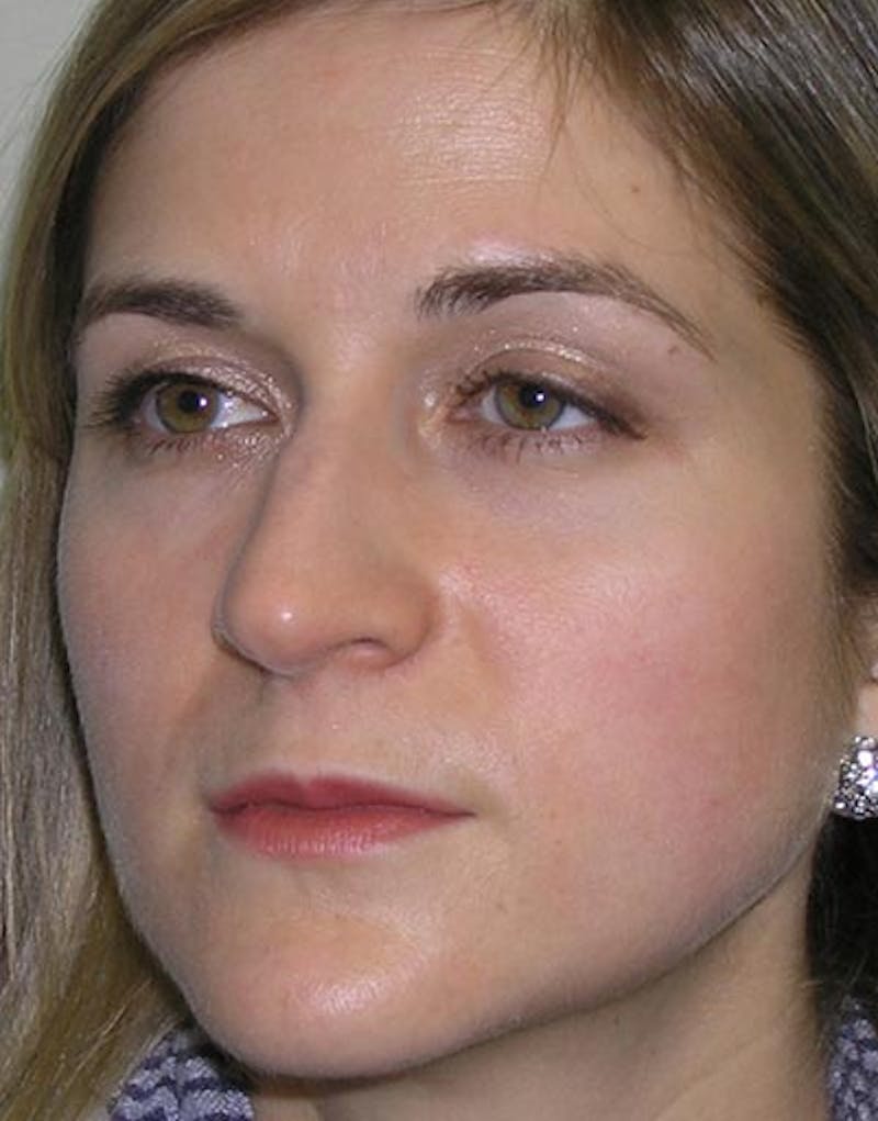 Rhinoplasty Before & After Gallery - Patient 308774 - Image 5