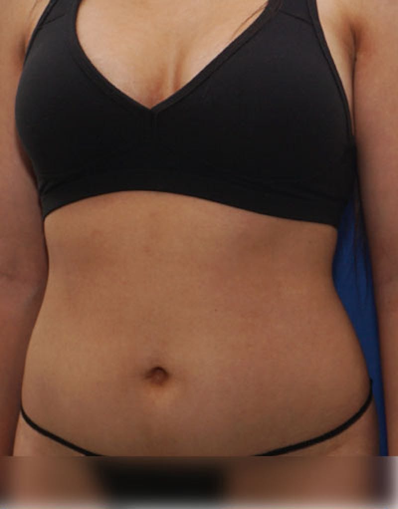 Liposuction (Body) Before & After Gallery - Patient 255887 - Image 9