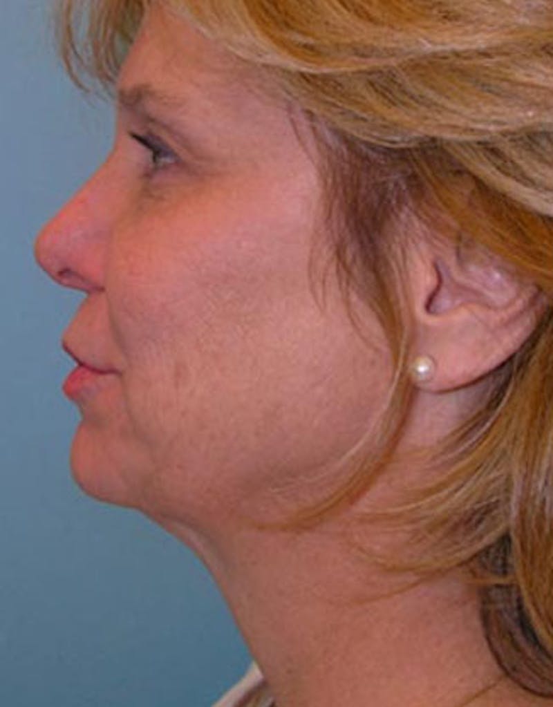 Patient YiReD6ITShq47xj823FC8Q - Jawline Contouring Before & After Photos