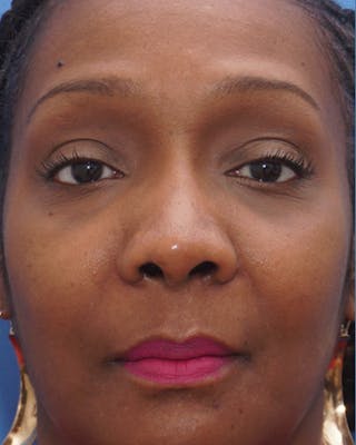 Rhinoplasty Before & After Gallery - Patient 251561 - Image 4