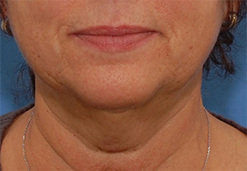 Facelift Before & After Gallery - Patient 177954 - Image 7